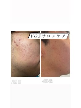 ビューティー アディクト(Beauty addict)/肌質が激変する！VOSサロンケア