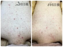 シェミー(CHEZ MEE)/【美ボディ】背中ニキビケア