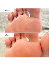 ケアプラス(care plus)/足裏角質ケア