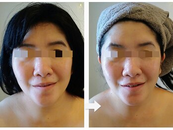 サラサ(SARASA)/シミケア・小顔ケア