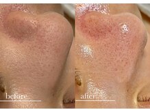 毛穴の開きも、まずは余分な皮脂や古い角質を除去することが重要