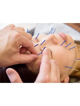 鍼灸施術を受けたい