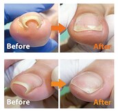 巻き爪補正店 富山店