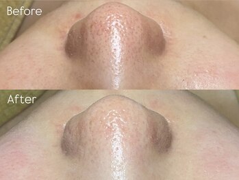 ミーラヤ(MILAYA)/梅田毛穴/梅田リアボーテ