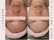 ファシネアオヤマ(FACINE AOYAMA)/強い赤みもここまでの変化♪