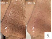 【毛穴洗浄】黒ずみを根本除去！みずみずしい引き締まったお肌に