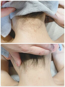 サロン ルアナ(salon luana)/うなじ脱毛
