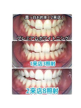 ホワイトニングビューティー 吉祥寺店/症例写真_2回来店されたお客様