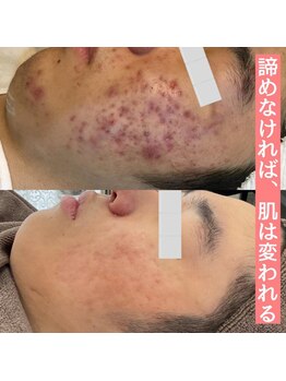 ゾーンビューティーハウス 松戸店(ZONE BEAUTY HOUSE)/メンズ しつこいニキビケア★