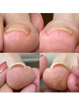 ウェルズユキ(well's yuki)/巻き爪（爪が薄い／割れる）