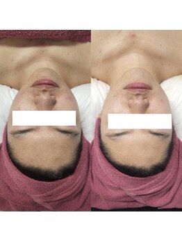 ラヴィ(La vie)/ハーブピーリング/ニキビケア