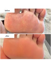 ケアプラス(care plus)/足裏角質ケア