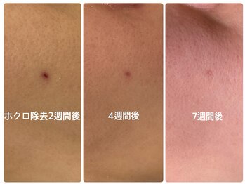 ハーブピーリング 恵比寿/ハーブピーリング