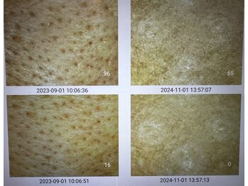 アキュセル ヨウコナース アンド 暢子美容鍼灸(Accu:Cell Youko nurse)/毛穴開き　毛穴汚れ