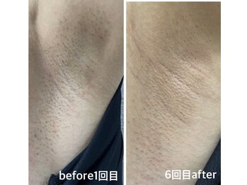 セルフ脱毛サロン SELFMADE イオンタウン仙台泉大沢店【3/29 NEW OPEN(予定)】 /【ビフォーアフター】セルフ脱毛