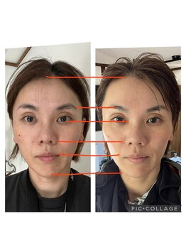 エステサロン BENE/顔の幅が短く！