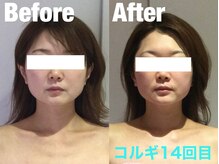 ビーキュート 学芸大学店(BE-CUTE)/Before/After　施術