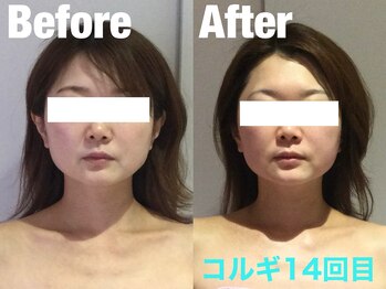 ビーキュート 学芸大学店(BE-CUTE)/Before/After 施術