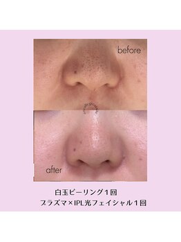 レジュイール(Rejouir)/白玉ピーリング×美白美肌コース