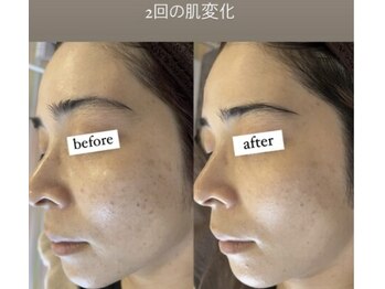 リ ラックス(Re:luxe)/★プロセルでどんな肌悩みにも★