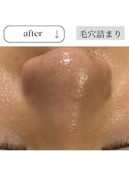 チューズ 北参道 代々木店(CHOOSE)/ピーリングと高濃度VCの相乗変化