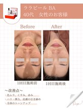 ミーカラー(mecalla.)/ララピールBA