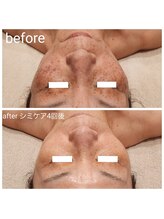 ルオント(LUONTO)/シミケア×光フェイシャル