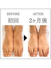 エクレ 今池店(EKURE)/脚脱毛