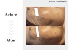 美活ラボ(美活LABO)/ハーブピーリング