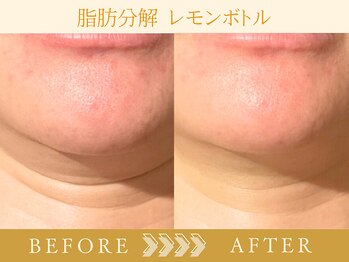 エステ ド フルール(Esthe de Fleur)/レモンボトルのBefore/After