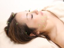 モリタ鍼灸整骨院/美肌リフト×美容鍼