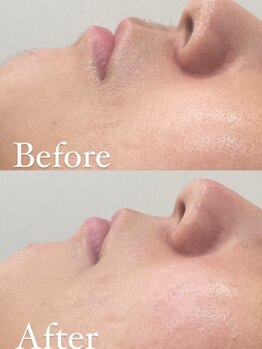 ラクシー 船橋(luxssy)の写真/【挙式直前・ブライダルシェービング】顔・うなじ・背中まで。熟練の技でドレスの映える輝く美肌へ