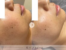 スパレーカ(Spa laka)/凹凸・色むらケア