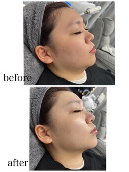 サロン ラピス 八幡駅店(Salon Lapis)/速攻小顔×磁気パック