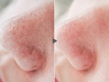 クリード(CLEAD)/ハイドラ/カーボキシーパック