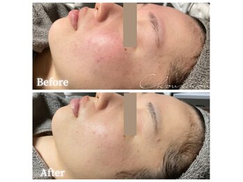 シュシュ(Chou chou)/【Before★After】赤み・乾燥