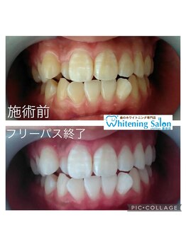 シフォン 豊田店/3週間通い放題フリーパスコース