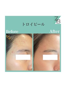 ザラハビューティー(ZARAHA Beauty)/トロイピール