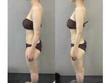 ヴィノ アイサロン(VINNO eyesalon)/最強！巻き肩＆バストアップ