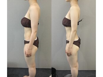 ヴィノ アイサロン(VINNO eyesalon)/最強！巻き肩＆バストアップ