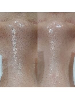 ボーソリューション(Beau-Solution)/【20代　サマー水光ピーリング】