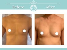 美人バスト 渋谷店/【バストアップ★育乳】症例