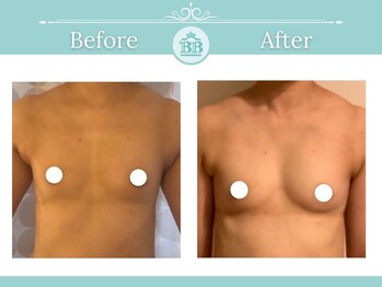 美人バスト 渋谷店/【バストアップ★育乳】症例