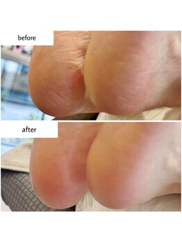 ケアプラス(care plus)/足裏角質ケア