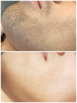 セブンボーテ(7Beaut'e)/ひげ脱毛♪