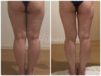 エルール トータルビューティ(Aileure total beauty)/インディバ,アミノ酸,燃焼ジェル