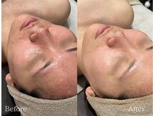 TD 鵜沼店/ハーブピーリング