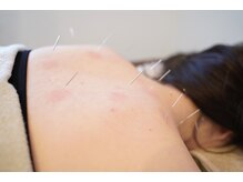 ストリ(STRI)/不調に合わせた鍼＋よもぎ蒸し