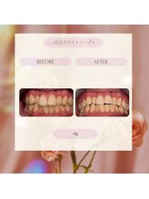 プラスビー 3号店(+b)/ホワイトニングビフォーアフター