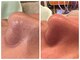 ハリモア(HARIMORE)の写真/３D毛穴ケアで理想の肌へ。毛穴の黒ずみをなくしたいと毛穴の開きをなおしたい人へ！